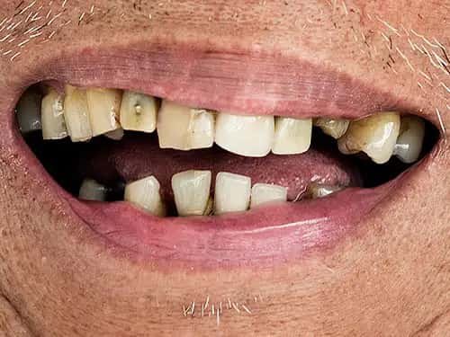 Missing One or More Teeth