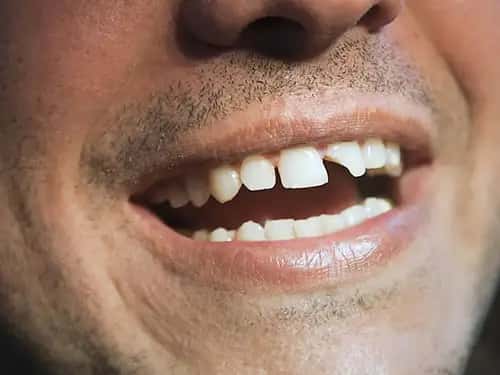 Cracked or Severely Damaged Teeth