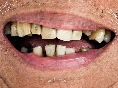 Missing One or More Teeth
